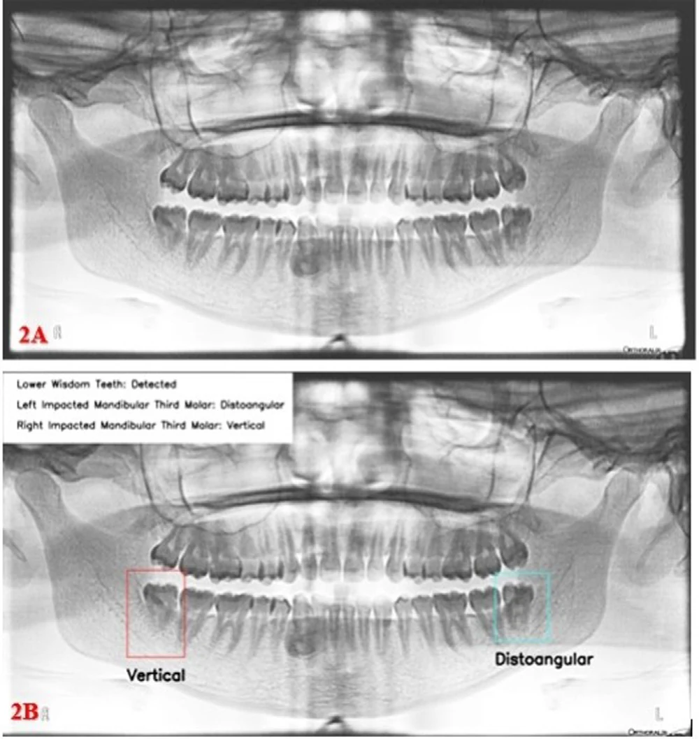 Panoramic X-ray before and after processing, with the detected wisdom teeth labelled vertical and distoangular.